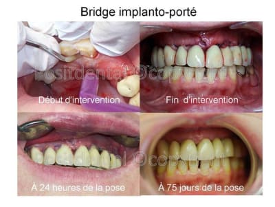 Bridge implanto port  03 lqj7c8 - Eugenol