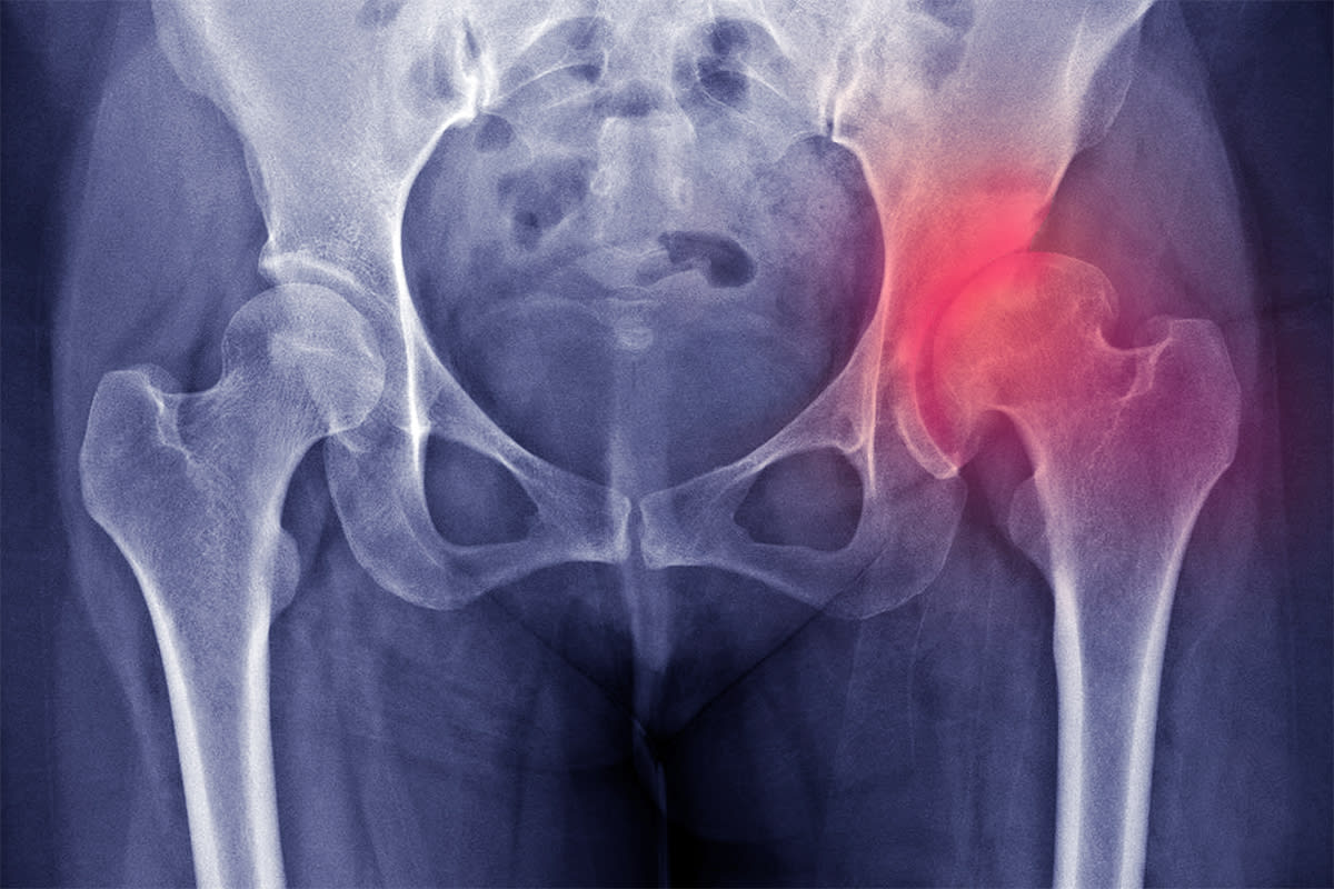 Hip dysplasia