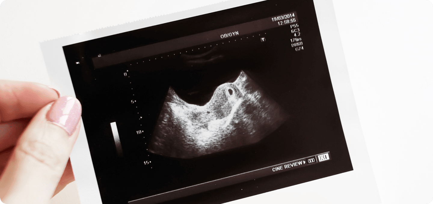 Gestational sac in ultrasound