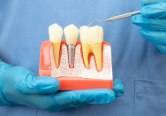 Eine Person im blauen Kittel und mit blauen Handschuhen hält ein Teilmodell des Kiefers. Zwischen zwei natürlichen Zähnen steht ein Zahnimplantat.