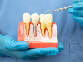 Eine Person im blauen Kittel und mit blauen Handschuhen hält ein Teilmodell des Kiefers. Zwischen zwei natürlichen Zähnen steht ein Zahnimplantat.