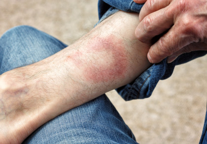 Nahaufnahme von einem Bein eines Mannes in blauer Jeans, das eine deutliche gerötete Hautstelle zeigt. Eine Hand hält die Jeans hoch, um die Rötung zu zeigen.