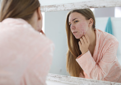 Eine junge Frau mit langen braunen Haaren betrachtet ihr Gesicht im Spiegel. Sie trägt einen rosa Bademantel und untersucht die Akne auf ihrer Wange mit den Fingern. Das Bild zeigt eine Nahaufnahme ihres reflektierten Gesichts im Spiegel.