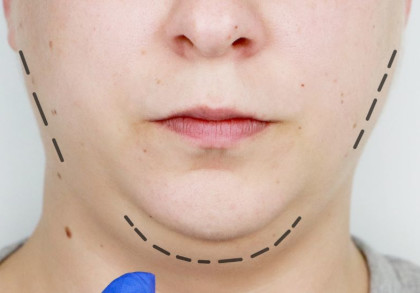 Die untere Hälfte eines Gesichts mit gestrichelten Linie ist ein Facelift angedeutet.