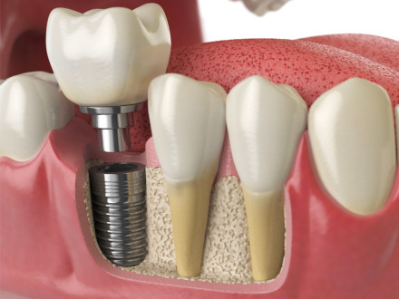 Dies ist eine 3D-Darstellung eines Zahnimplantats im Querschnitt. Das Bild zeigt ein Zahnimplantat, das in den Kieferknochen eingesetzt ist. Das Implantat besteht aus einem metallischen, schraubenartigen Pfosten, der im Knochen verankert ist.