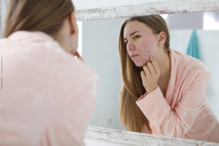 Eine junge Frau mit langen braunen Haaren betrachtet ihr Gesicht im Spiegel. Sie trägt einen rosa Bademantel und untersucht die Akne auf ihrer Wange mit den Fingern. Das Bild zeigt eine Nahaufnahme ihres reflektierten Gesichts im Spiegel.