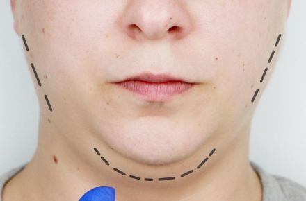Die untere Hälfte eines Gesichts mit gestrichelten Linie ist ein Facelift angedeutet.