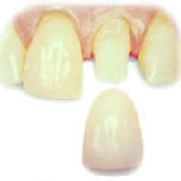 Dental crown 1  z2yues - Eugenol