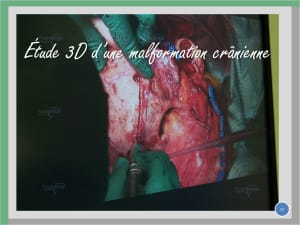 Étude 3d d une malformation crânienne 12 lzttg1 - Eugenol