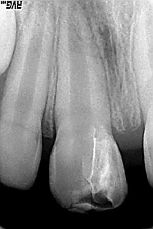 10 jours après bolpdx - Eugenol