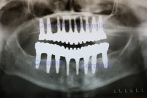 18 implants  1  tdcxcr - Eugenol