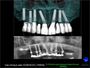 20 extraction mci bridge provisoire avec armature m tal dquhgf - Eugenol