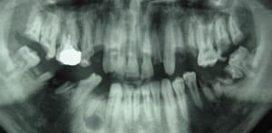 26 ans toutes ses dents    a8z56l - Eugenol