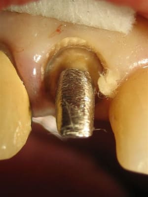 2ième fil lrgvfi - Eugenol