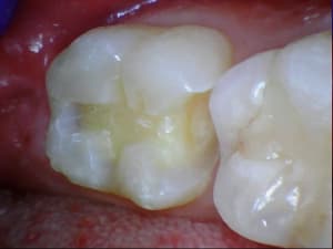 37 inlay 20111019 3 5 ue3urz - Eugenol