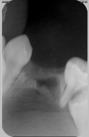 74 après ext début ouverture oeiosw - Eugenol