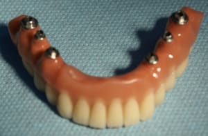 7 sans guide seconde proth se avec armature titane isus sur premi re empreinte zmpufa - Eugenol