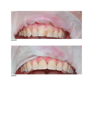 Avantapres mlrxhd - Eugenol