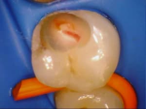 Biodentine eb09zb - Eugenol