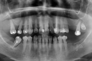 Caries sous gingivales cgvmbl - Eugenol