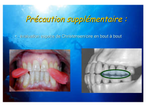 Cirebout bout heljpl - Eugenol