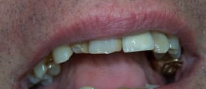 Copie de 2013 03 13 positdental 002 zsx5tz - Eugenol