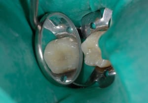 Dentine2 qjpodq - Eugenol