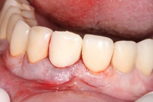 Eii mci  5  gppyri - Eugenol