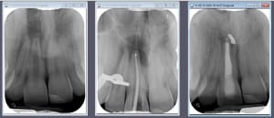Endo 11 c3ikls - Eugenol