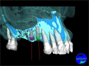 Guide chirurgical 004 f1p4ul - Eugenol