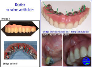 Gestion du balcon vestibulaire 3 aqvar5 - Eugenol