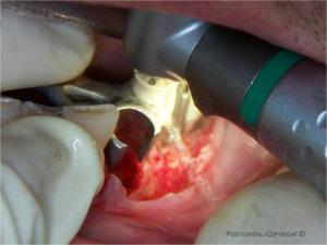 Guide chirurgical pnzvxc - Eugenol
