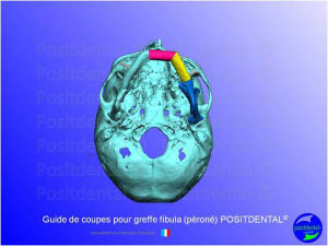 Guide de coupes pour greffe fibula  p ron   positdental 008 agltot - Eugenol
