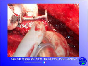 Guide de coupes pour greffe fibula  p ron   positdental 021 spfk57 - Eugenol