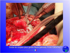 Guide de coupes pour greffe fibula  p ron   positdental 023 r3n5wa - Eugenol
