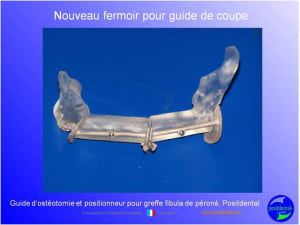 Guide de coupes pour greffe fibula  p ron    positdental 032 dsukz1 - Eugenol