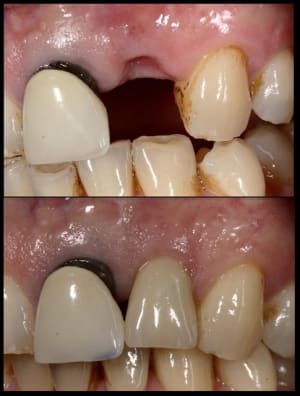 Implants kuuems - Eugenol