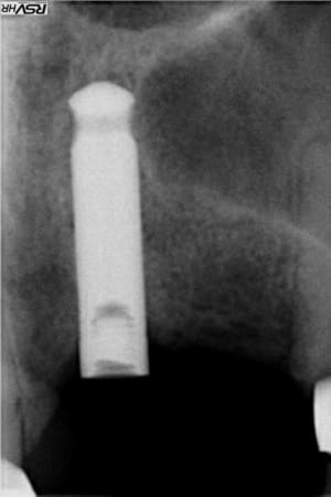 Implant c eg1k6g - Eugenol
