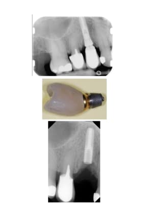 Implant easy previum jole3a - Eugenol
