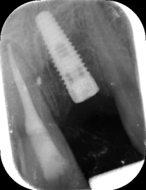 Implant21 eblca9 - Eugenol