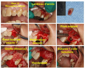 Implant 22 exo pose greffe notes  dteqav - Eugenol