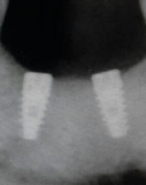 Implant 2 ug7dpr - Eugenol