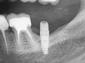 Implant x brjiao - Eugenol