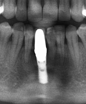 Implant inconnu 2 frywea - Eugenol