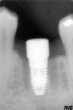 Implant ld8uaa - Eugenol