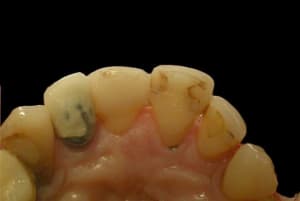 Inceram  2   small  i5jsv1 - Eugenol