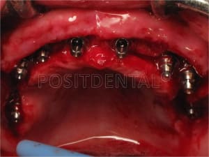 Lambeau   minima avec un guide chirurgical   appuis osseux 05 gujig5 - Eugenol