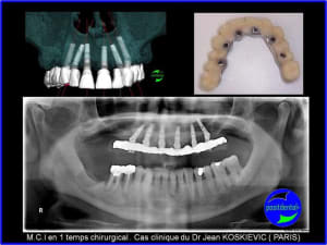 M.c.i en 1 temps chirurgical  - Eugenol