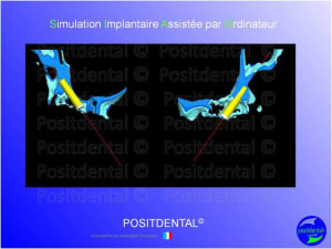 Mci  mise en charge imm diate  chirurgie implantaire guid e 005 byshxh - Eugenol