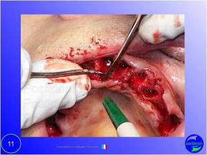 Mise en chage imm diate 011 wjw5b8 - Eugenol
